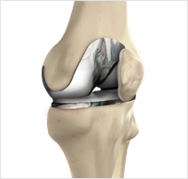 knee Preservation